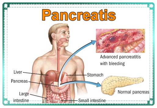 Acute pancreatis.jpg