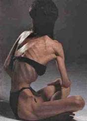 anorexia1